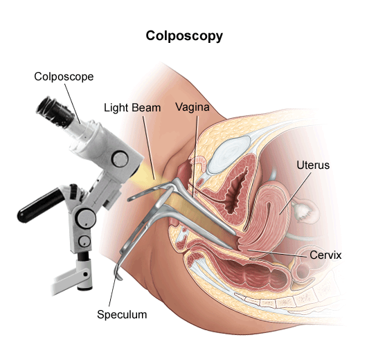 colposcopy-1