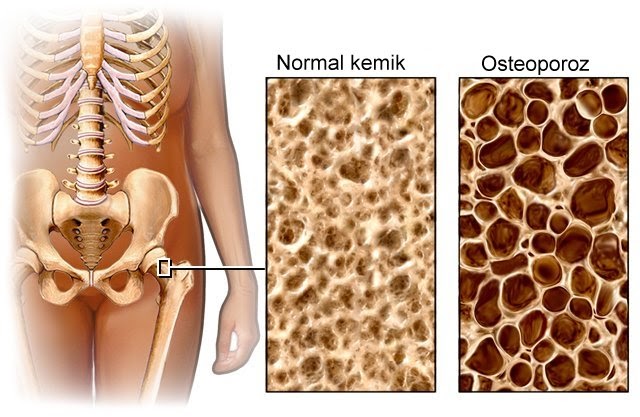 osteoporoz-1