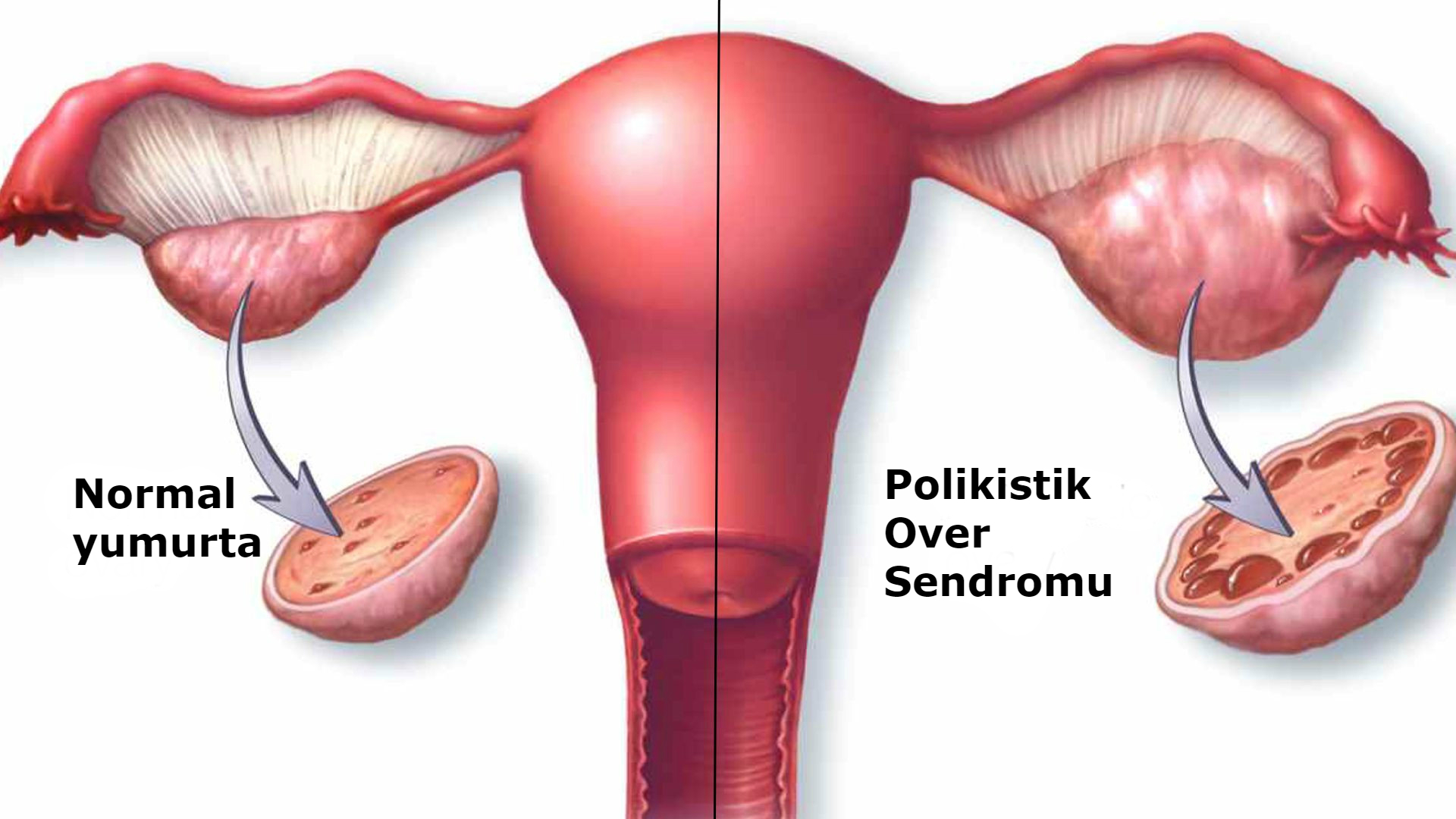 polikistik-over-sendromu-1