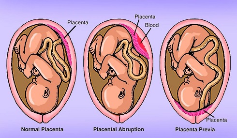 plasenta-previa-1